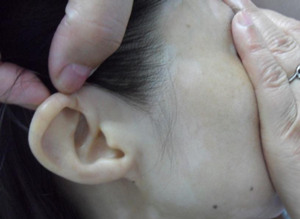 ��ȥ�沿�װߣ��޾�����ϴ�� 